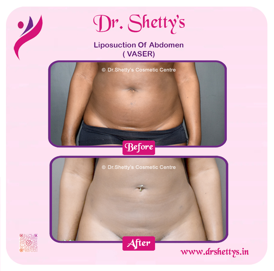 Liposuction 5