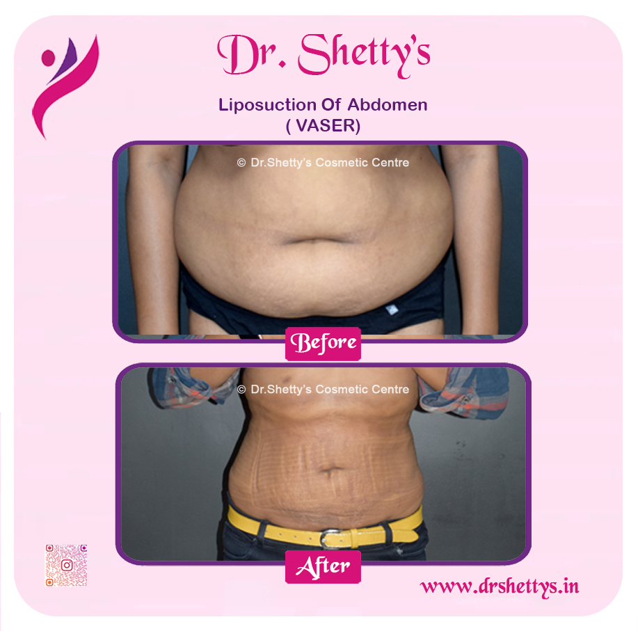 Liposuction 6