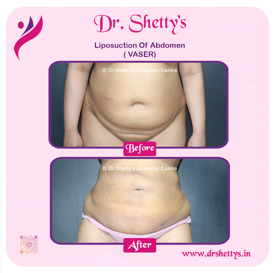 Liposuction 7