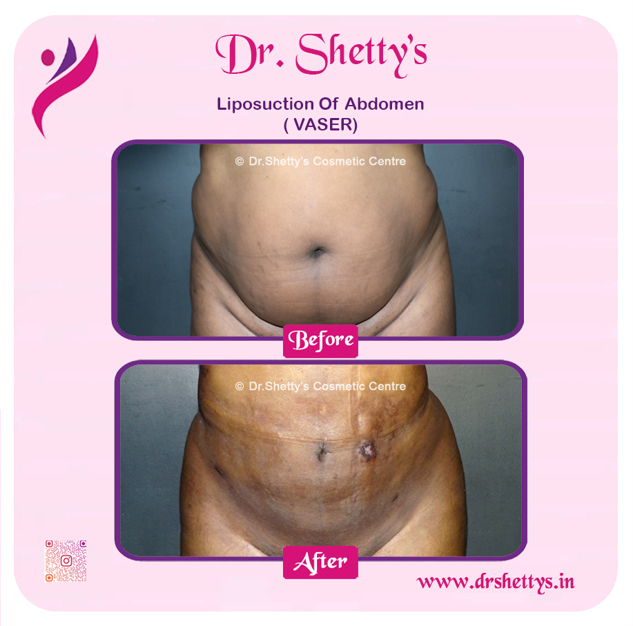 Liposuction 8
