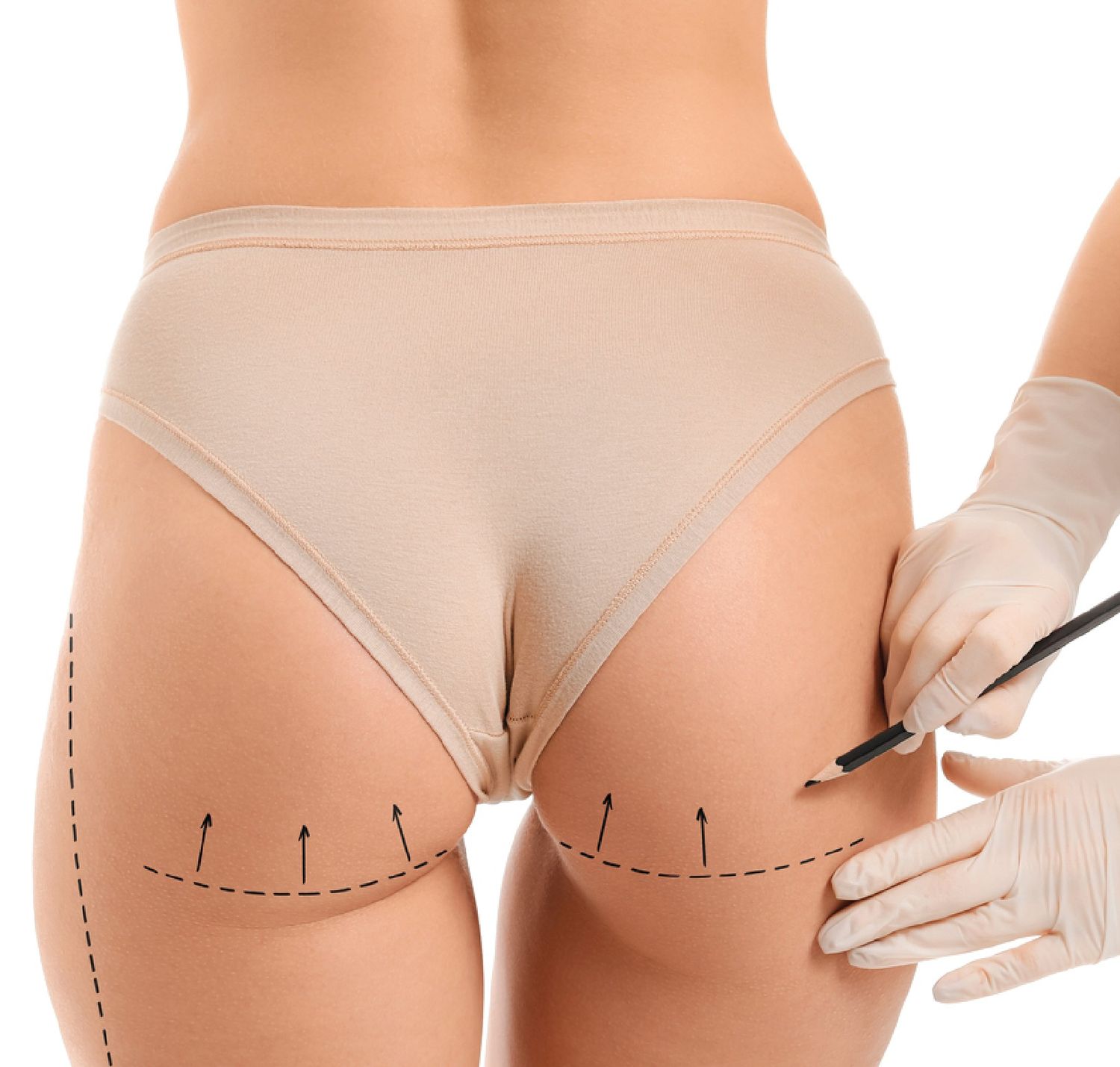 Liposuction butt