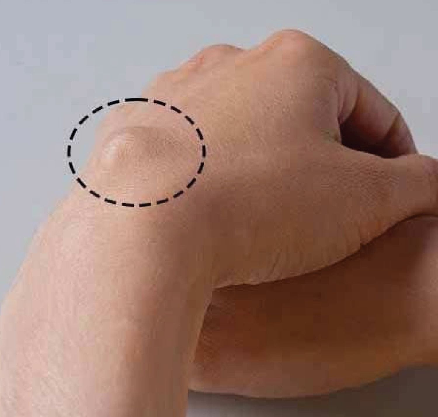 Liposuction