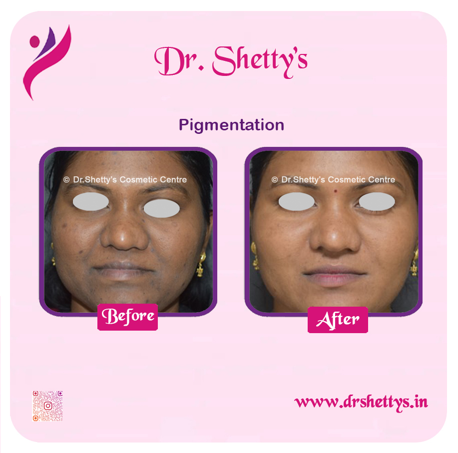 Melasma Treatment 10