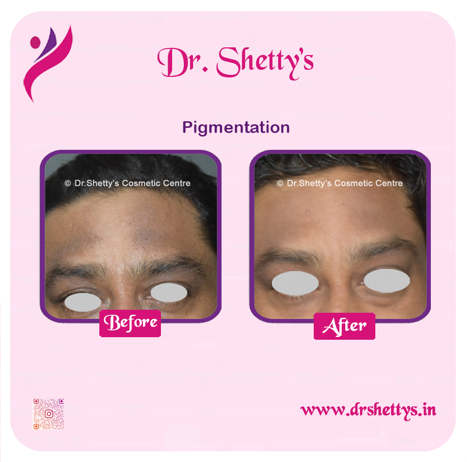 Melasma Treatment 11