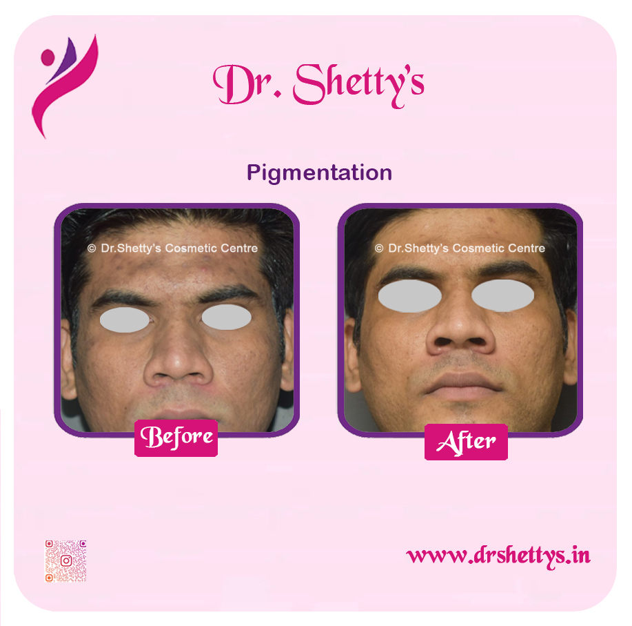Melasma Treatment 15