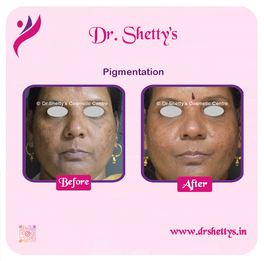 Melasma Treatment 17