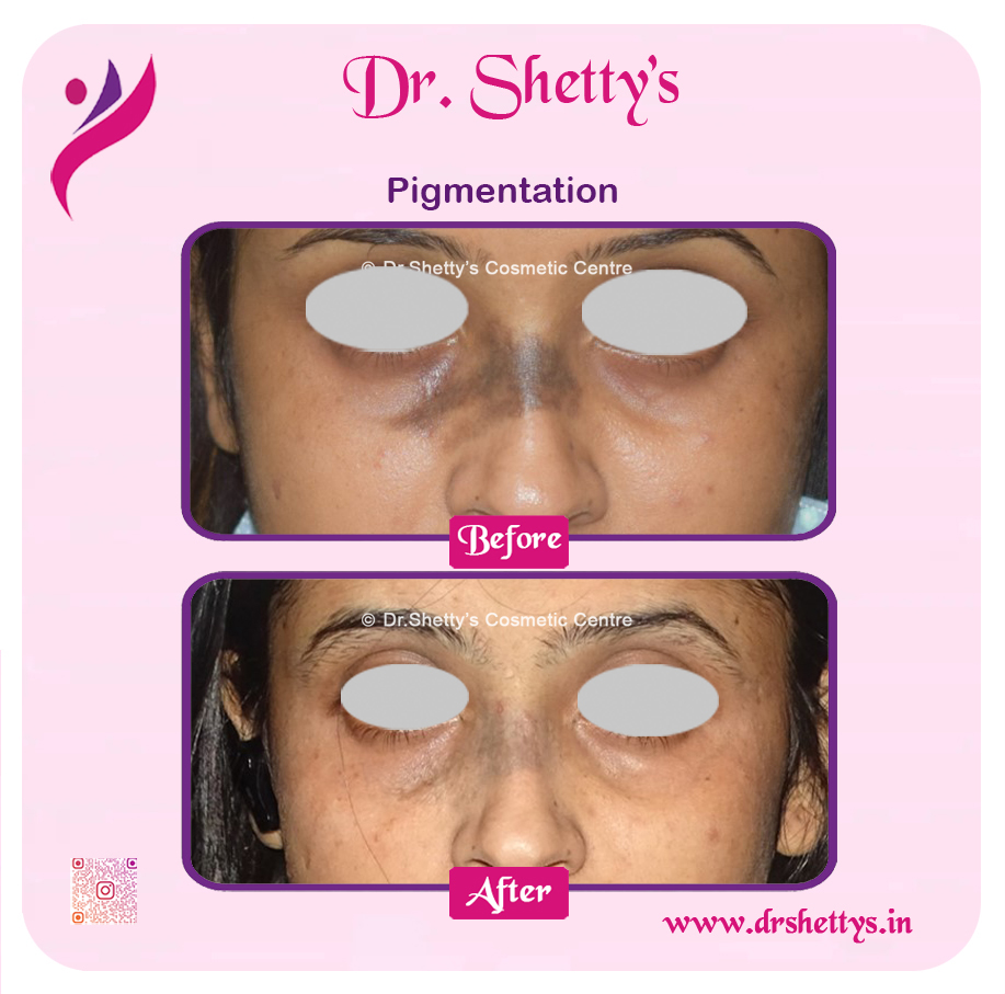Melasma Treatment 19