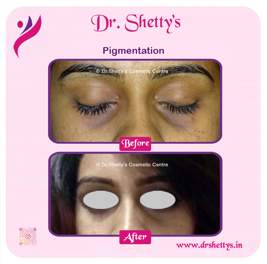 Melasma Treatment 2