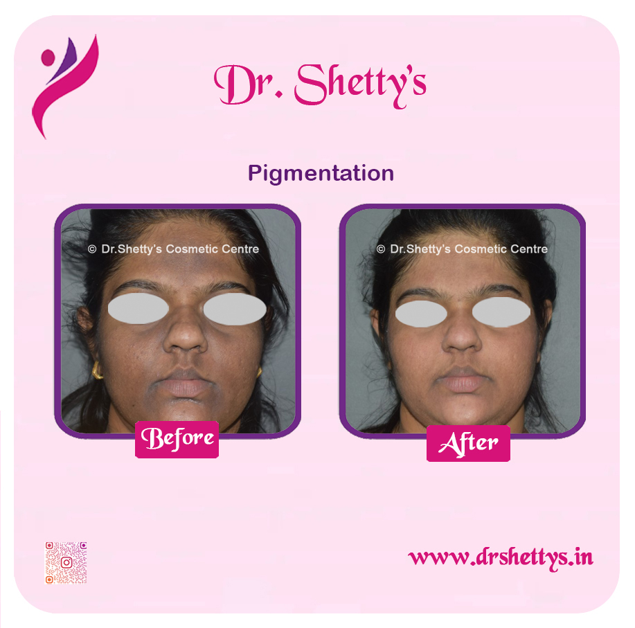 Melasma Treatment 21