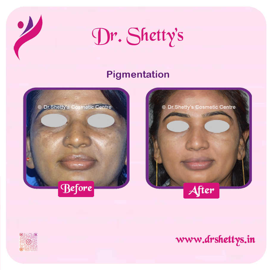 Melasma Treatment 3