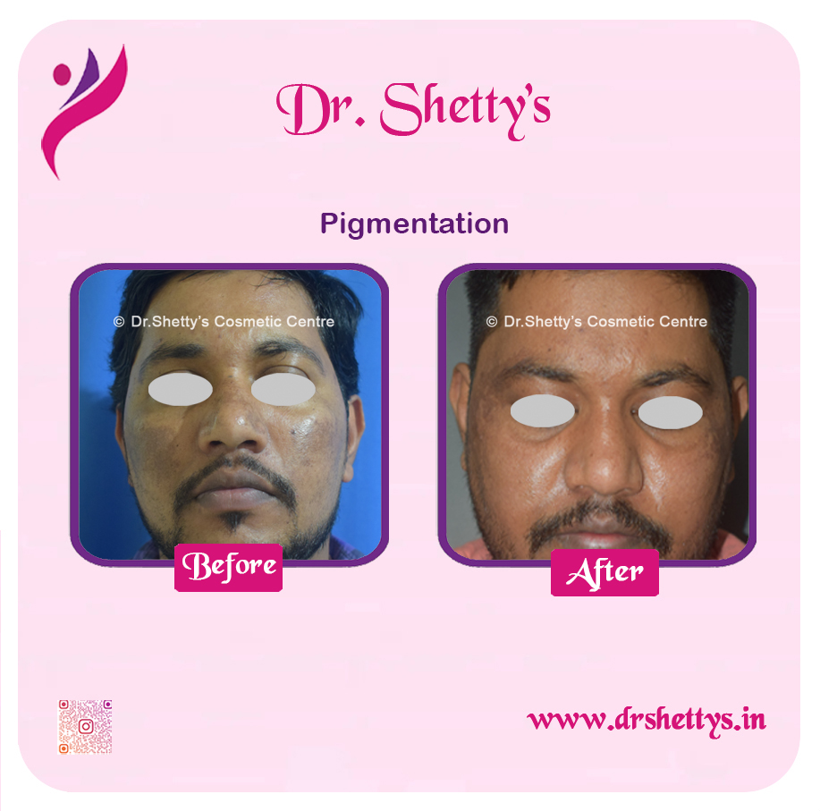 Melasma Treatment 5