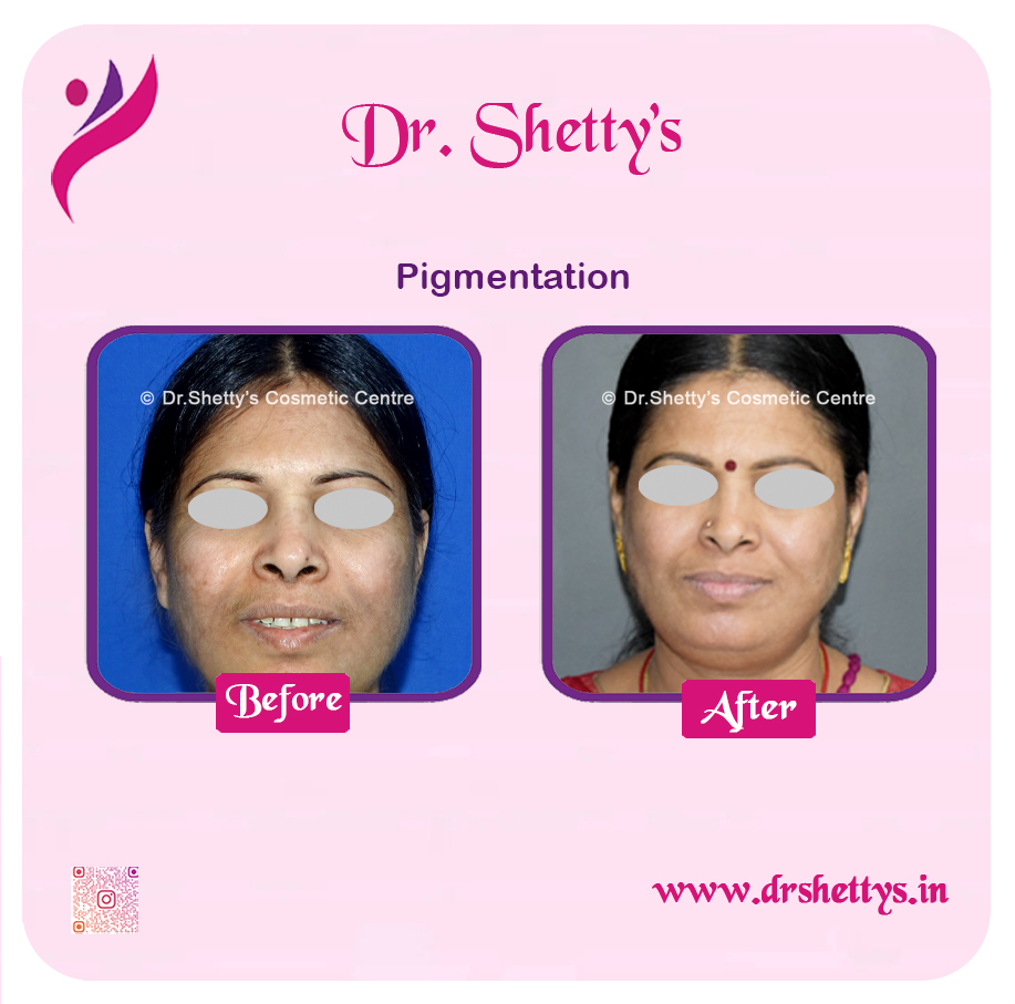 Melasma Treatment 7
