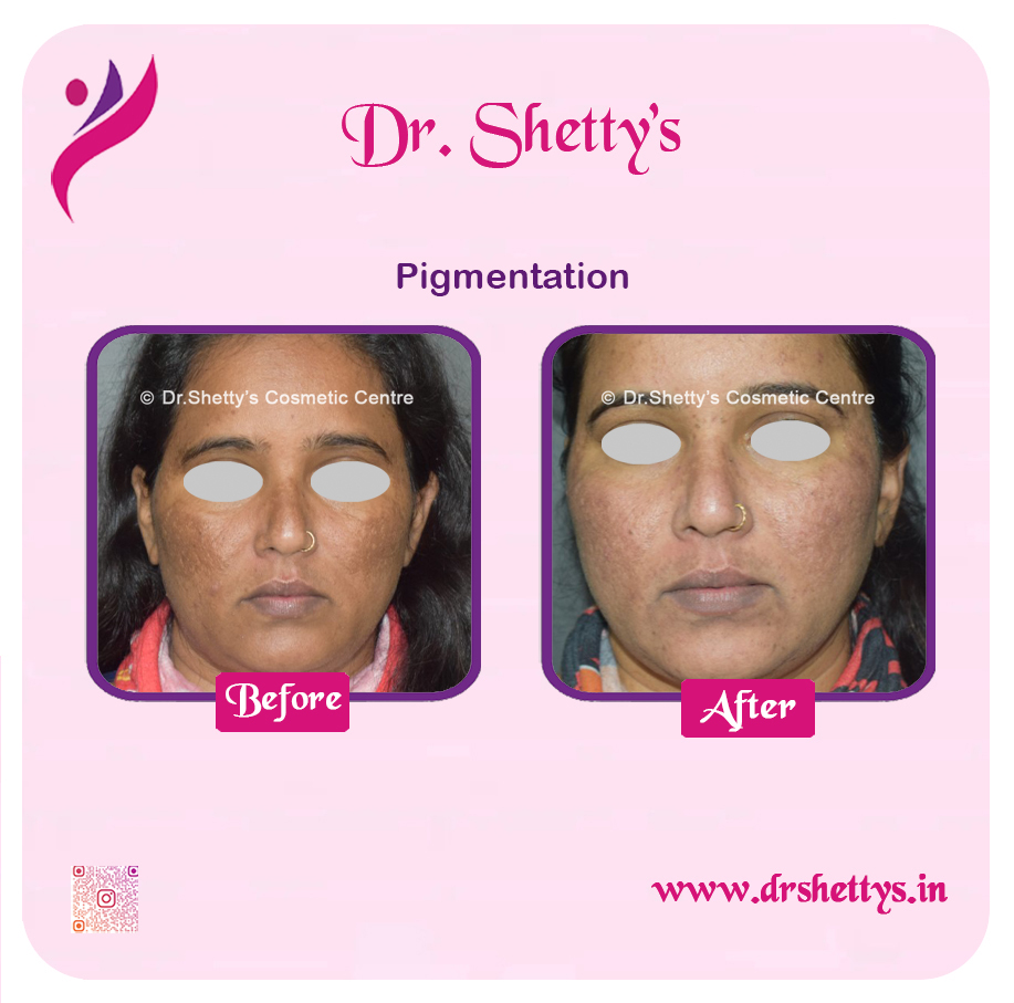 Melasma Treatment 8