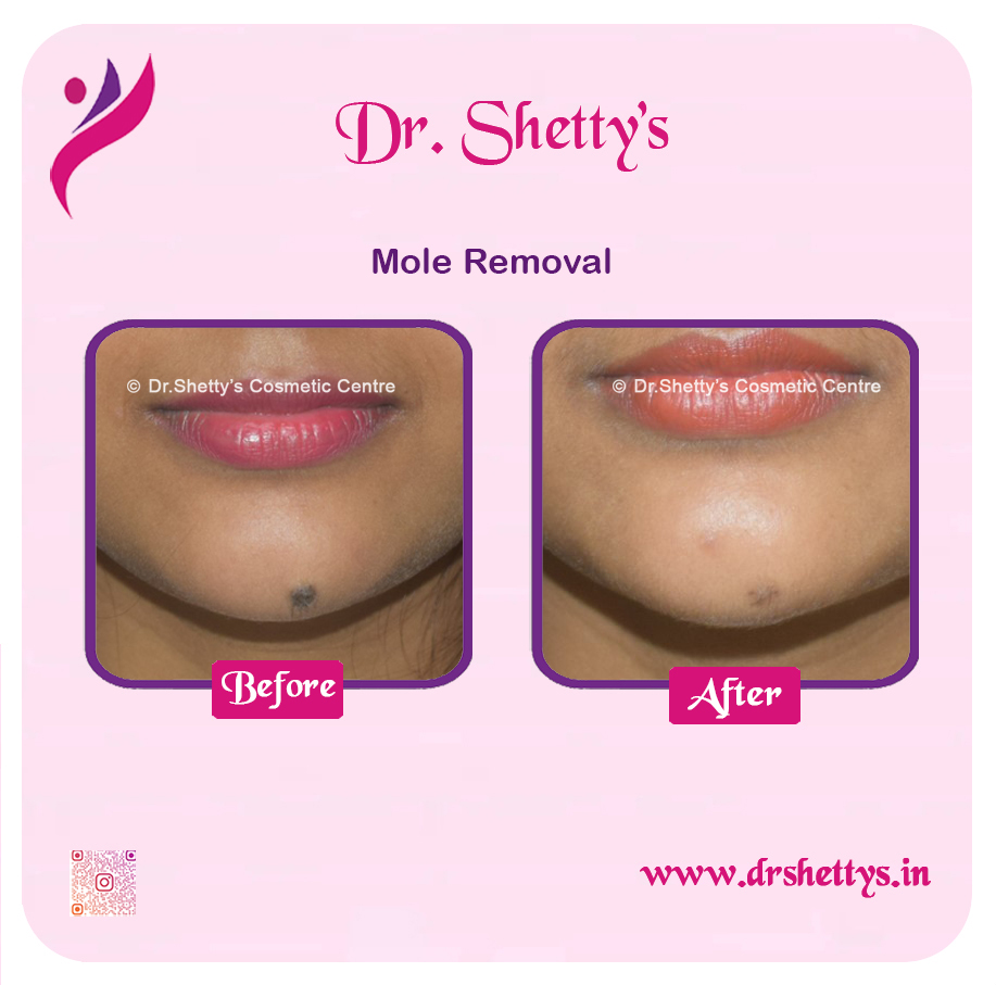 Moles and Warts Treatment 1