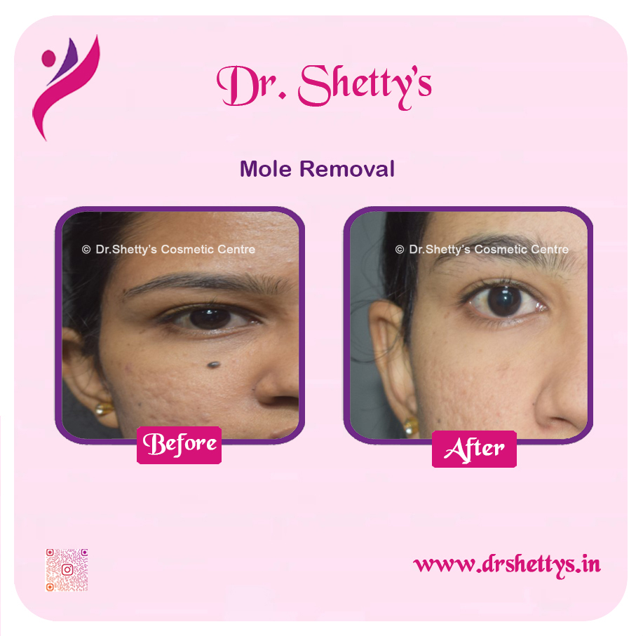 Moles and Warts Treatment 10