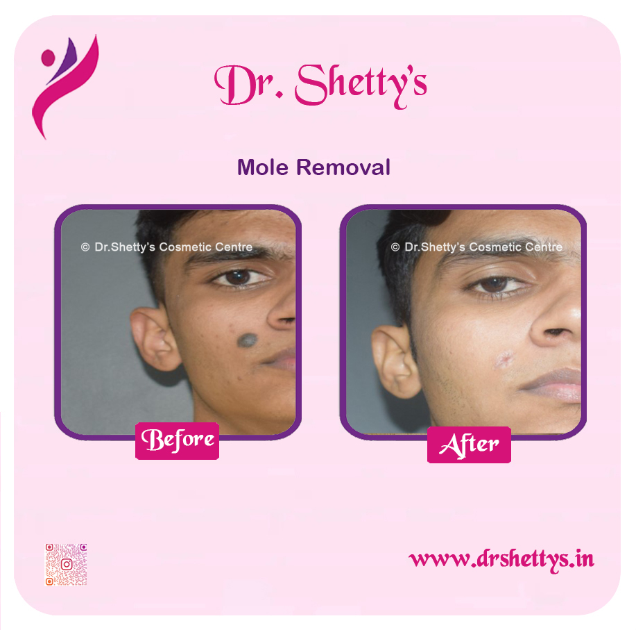 Moles and Warts Treatment 12