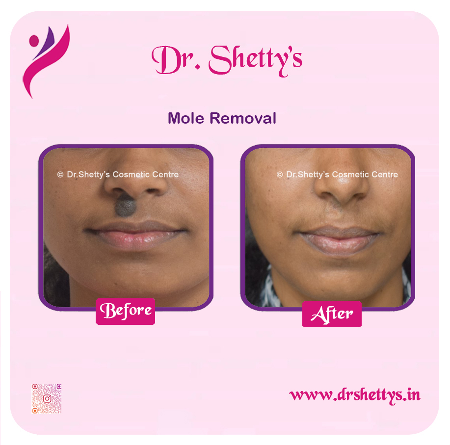 Moles and Warts Treatment 13