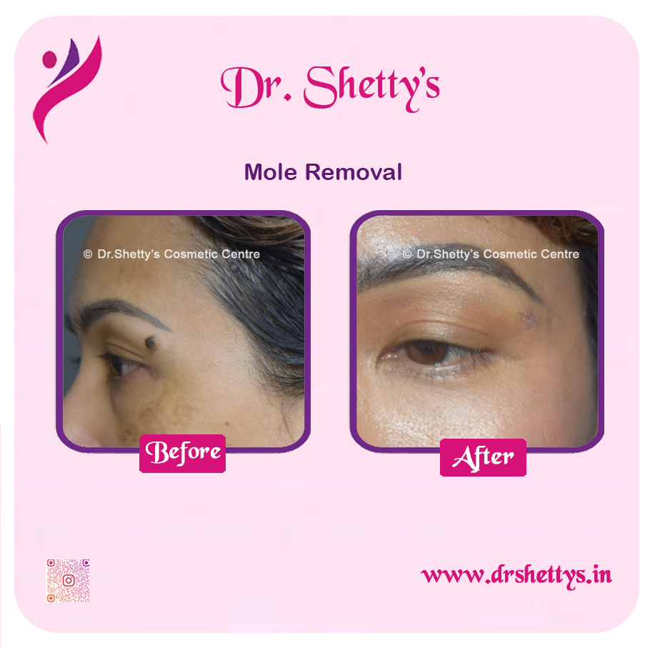 Moles and Warts Treatment 15