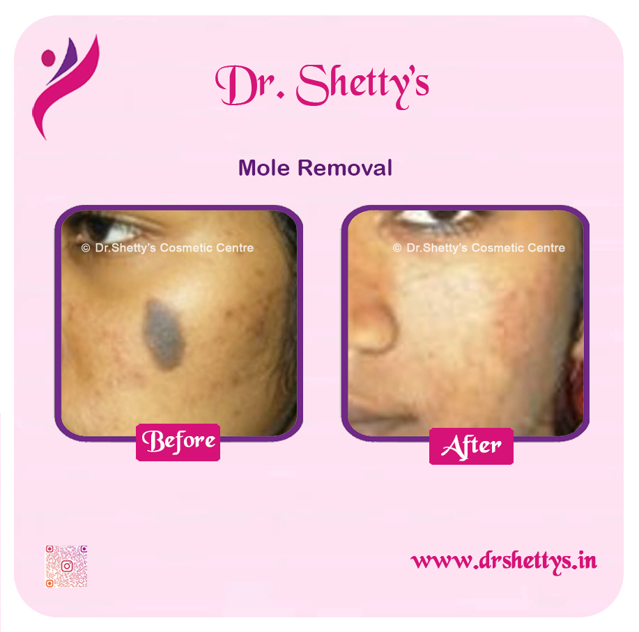 Moles and Warts Treatment 16