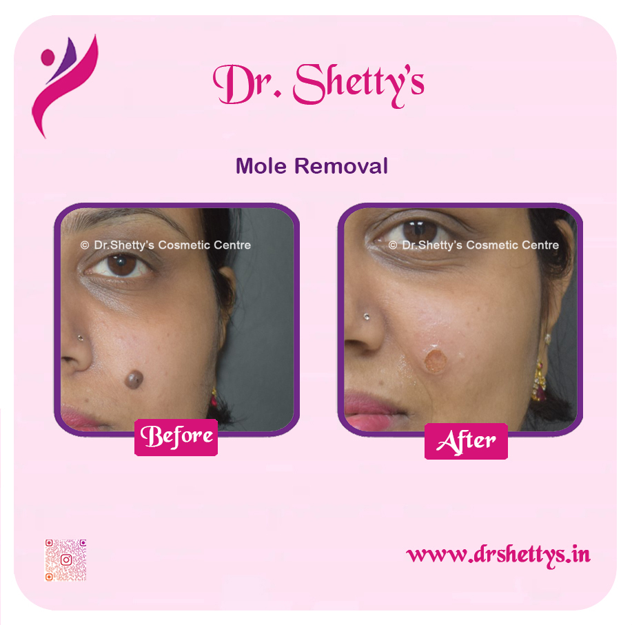 Moles and Warts Treatment 18