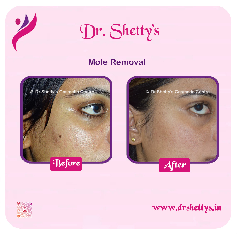 Moles and Warts Treatment 20