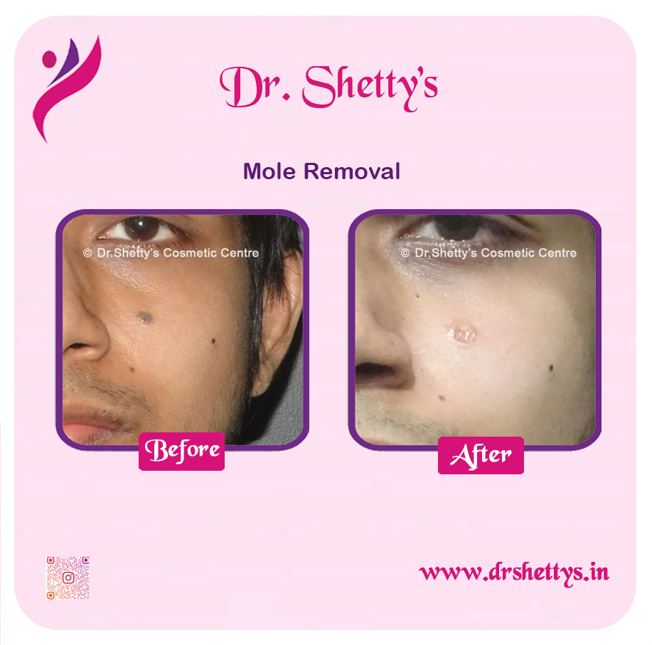 Moles and Warts Treatment 21