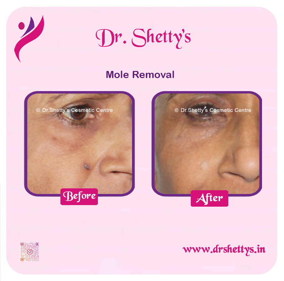 Moles and Warts Treatment 22