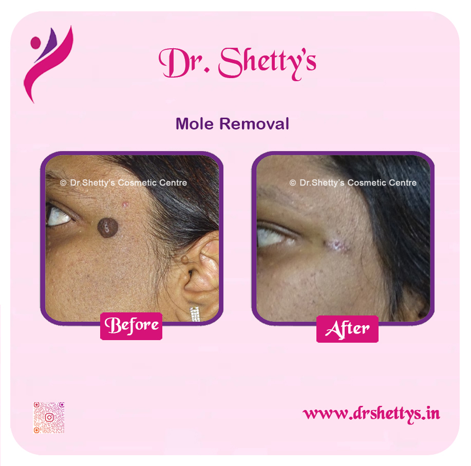 Moles and Warts Treatment 24