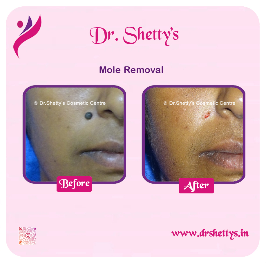 Moles and Warts Treatment 27