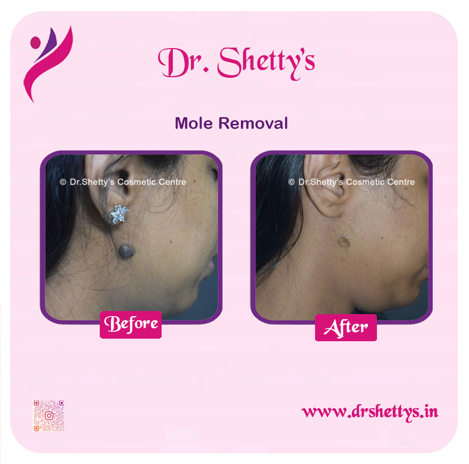Moles and Warts Treatment 29