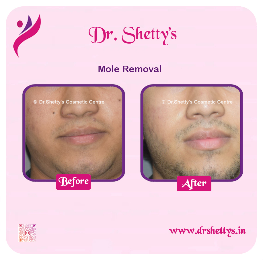 Moles and Warts Treatment 3