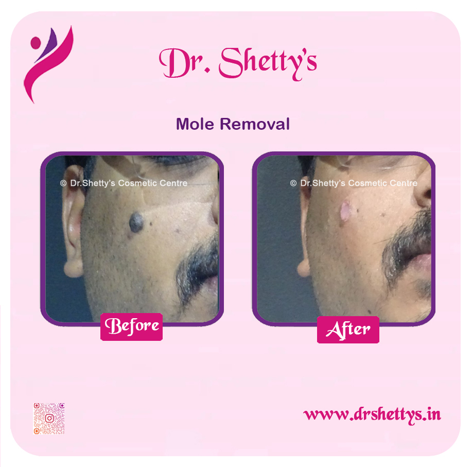 Moles and Warts Treatment 30