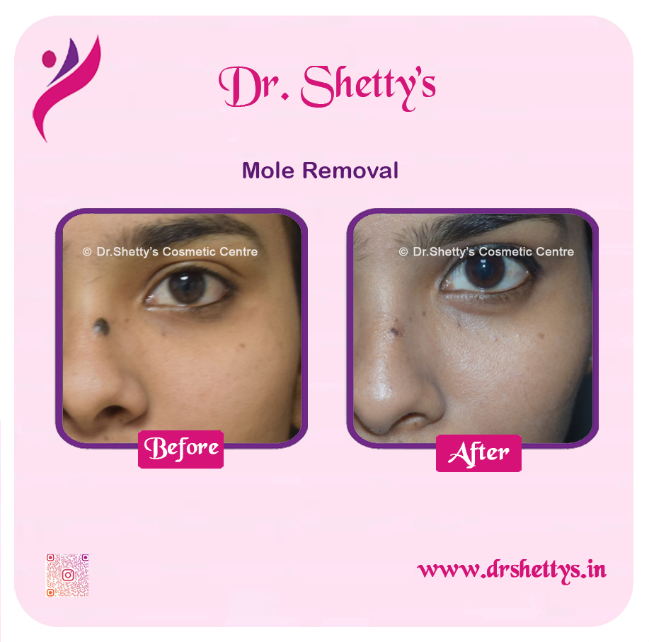 Moles and Warts Treatment 32