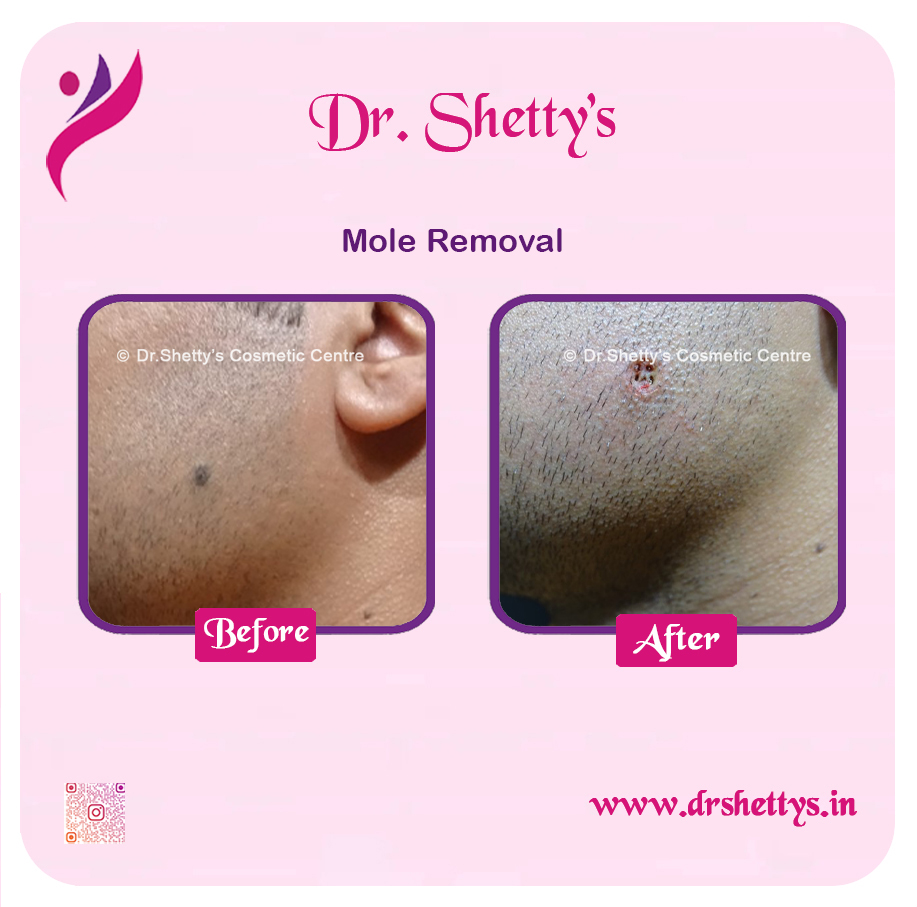 Moles and Warts Treatment 33