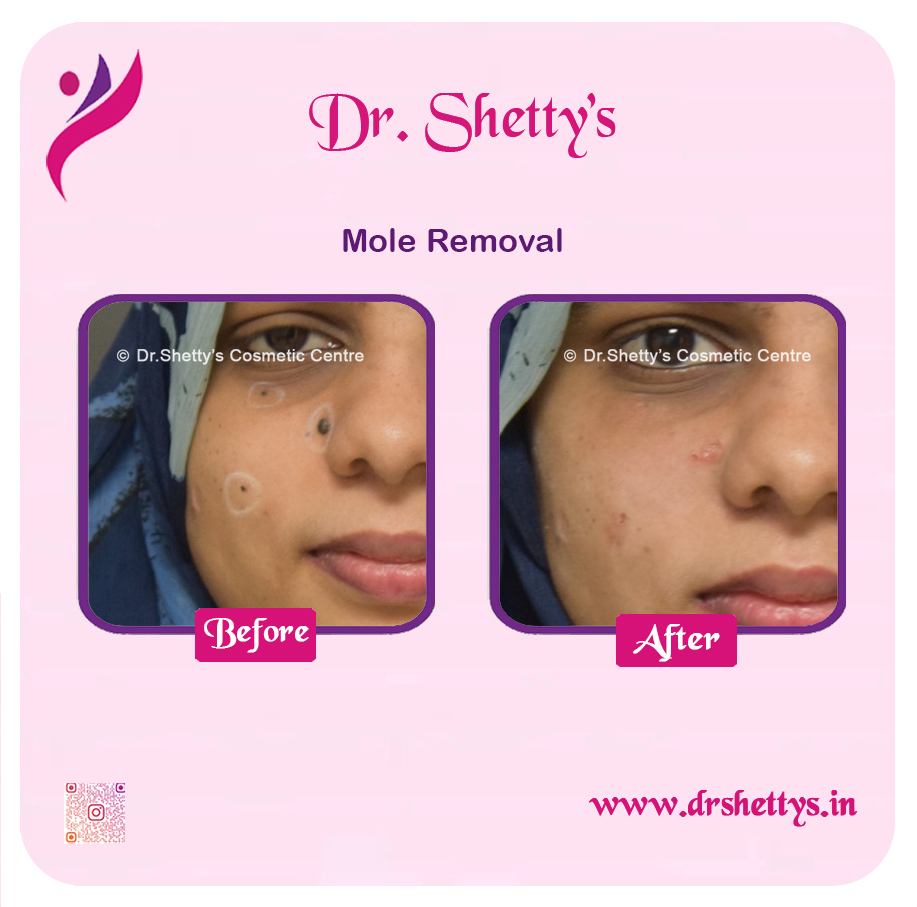 Moles and Warts Treatment 34