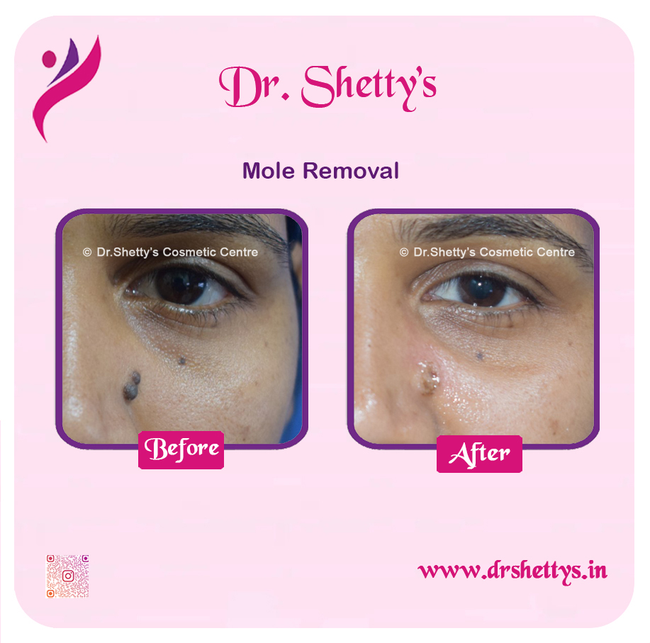 Moles and Warts Treatment 35