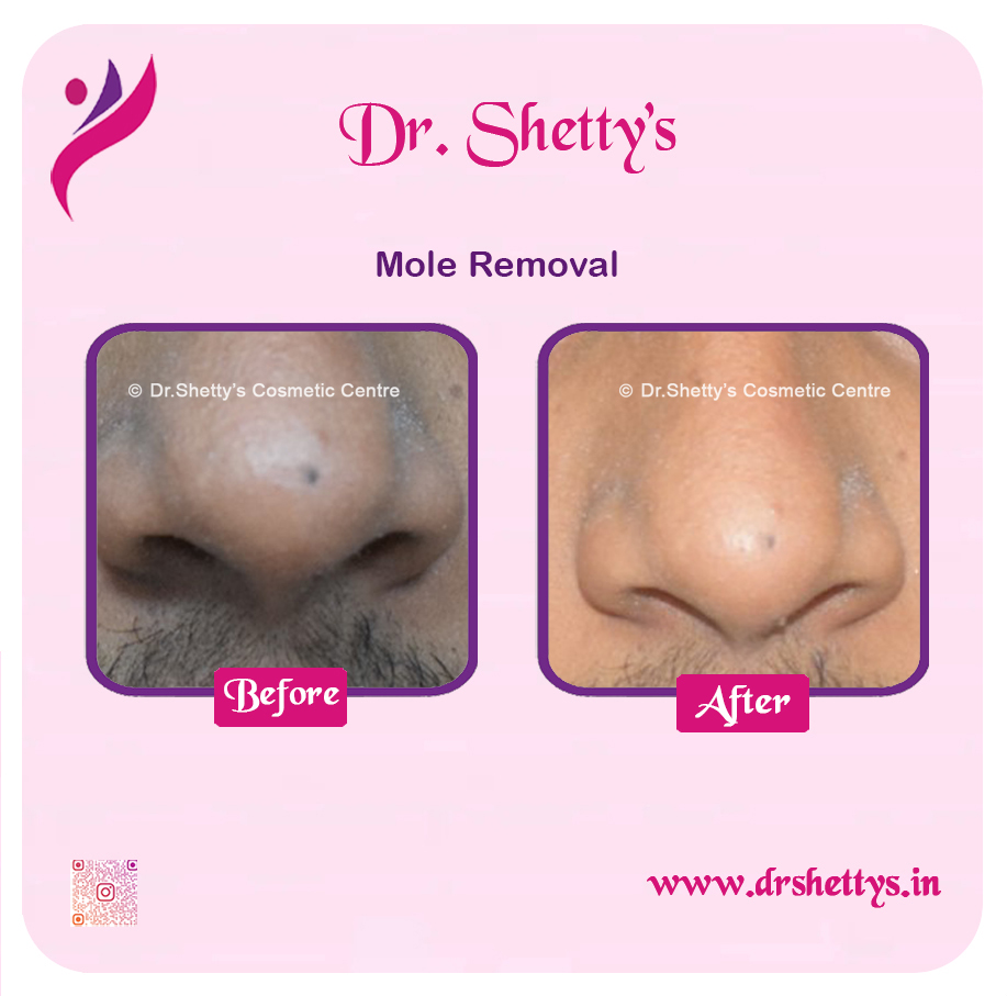 Moles and Warts Treatment 36