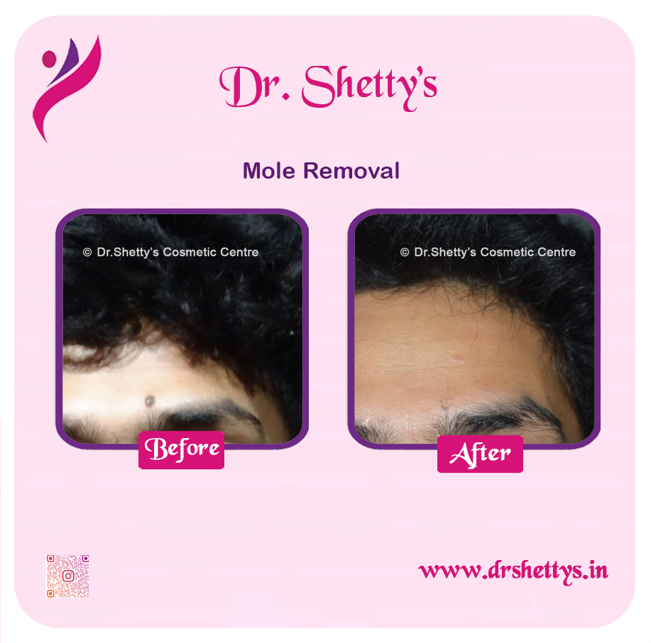 Moles and Warts Treatment 37