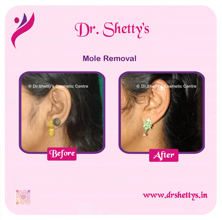 Moles and Warts Treatment 4