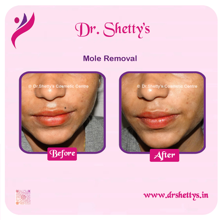 Moles and Warts Treatment 5
