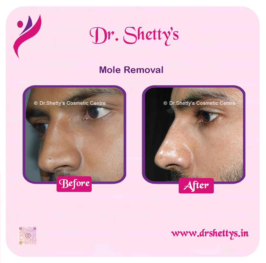 Moles and Warts Treatment 6