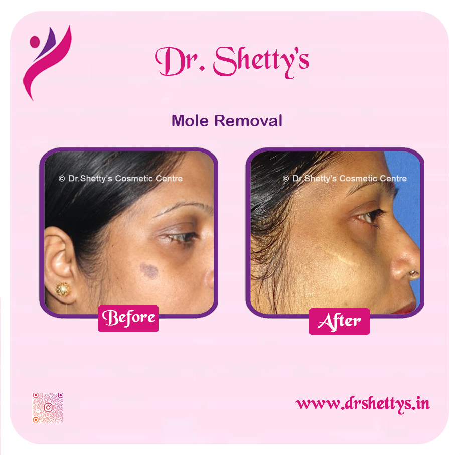 Moles and Warts Treatment 7