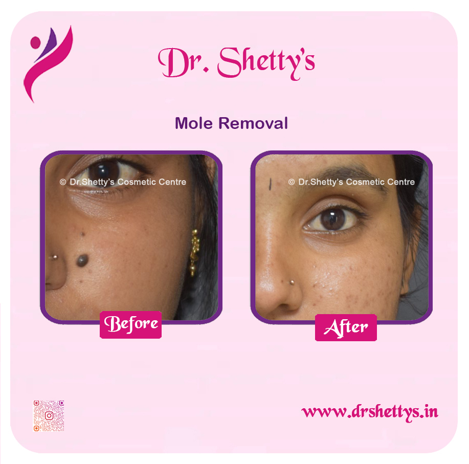 Moles and Warts Treatment 8