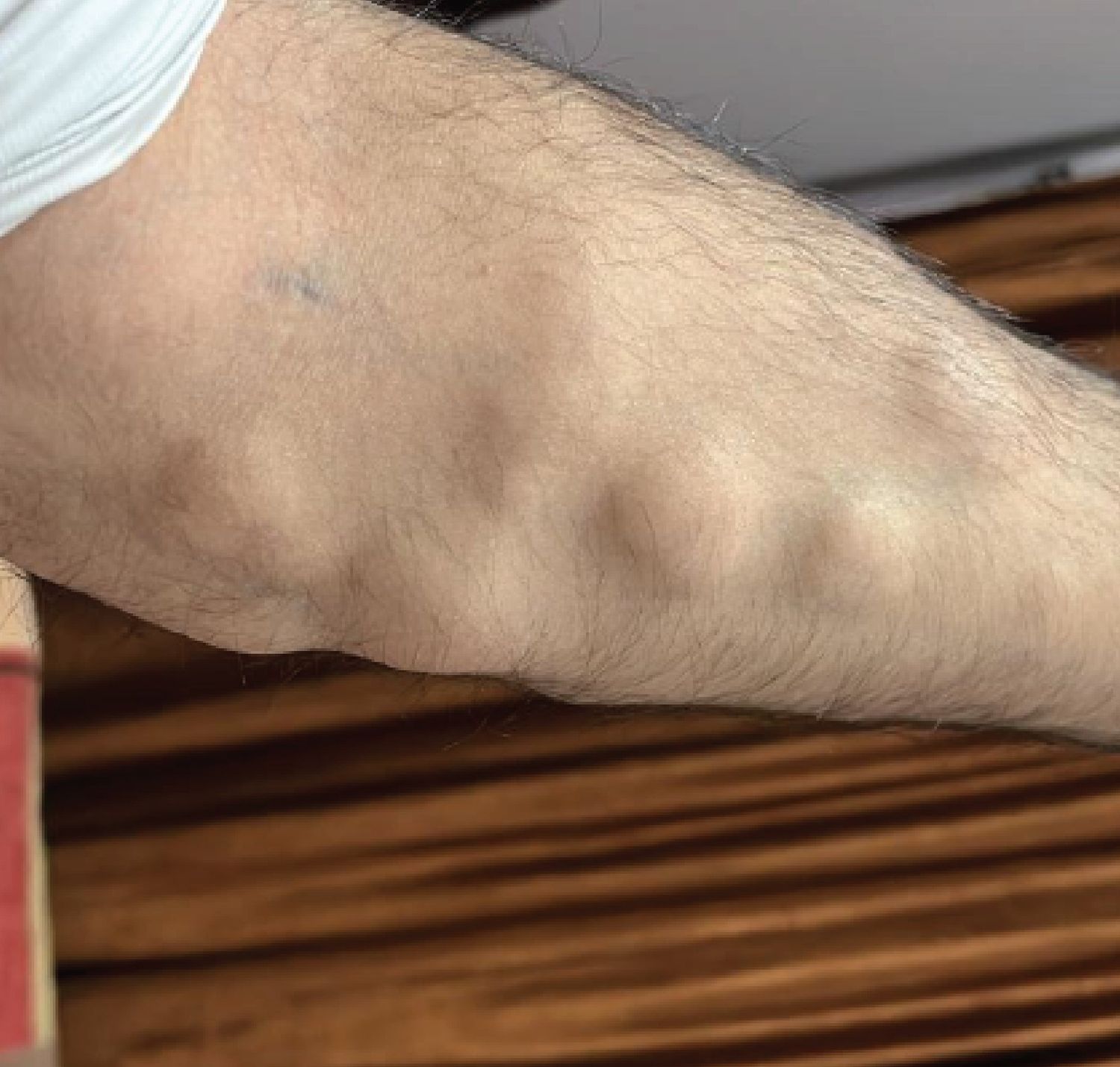 Multiple Lipoma Removal in OneSession