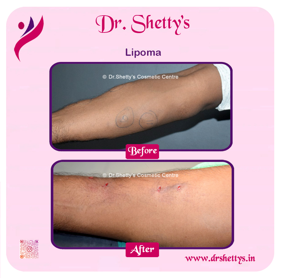 Multiple Lipoma Treatment 1