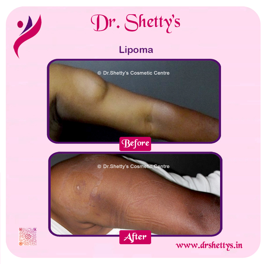 Multiple Lipoma Treatment 11