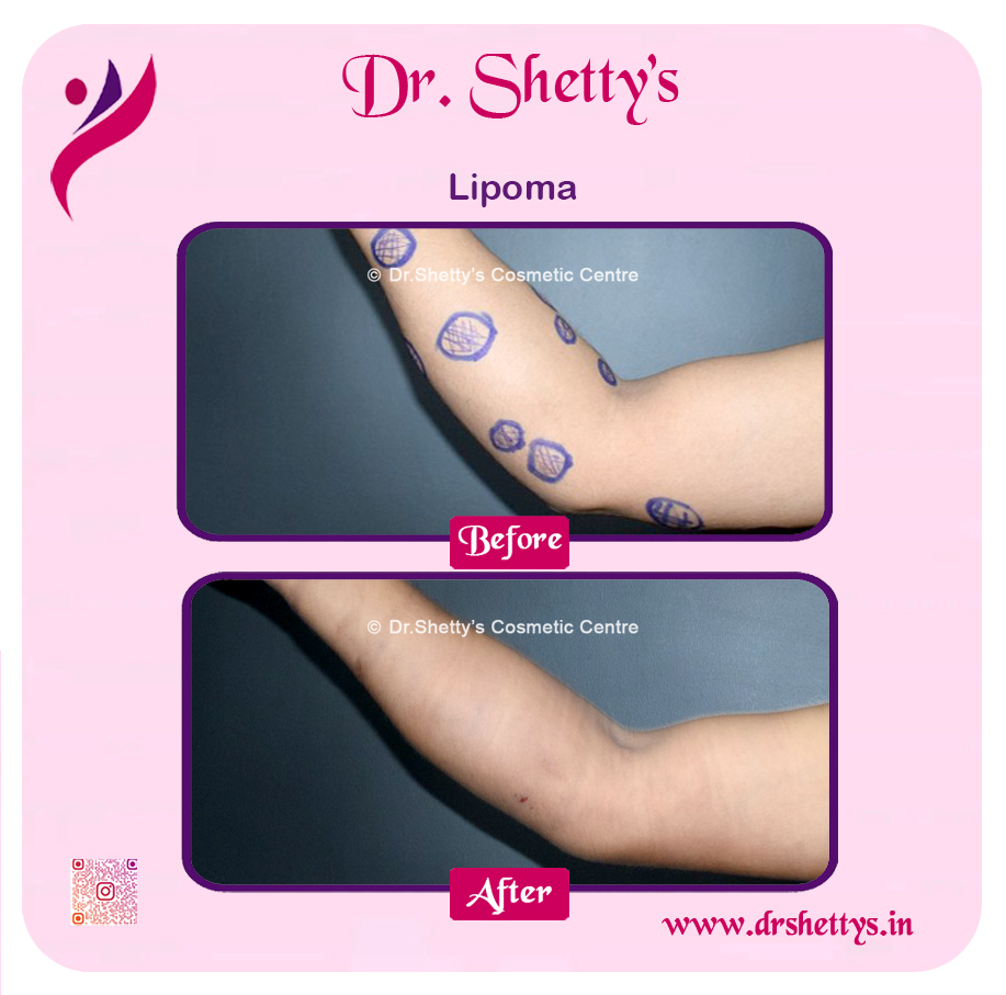 Multiple Lipoma Treatment 12