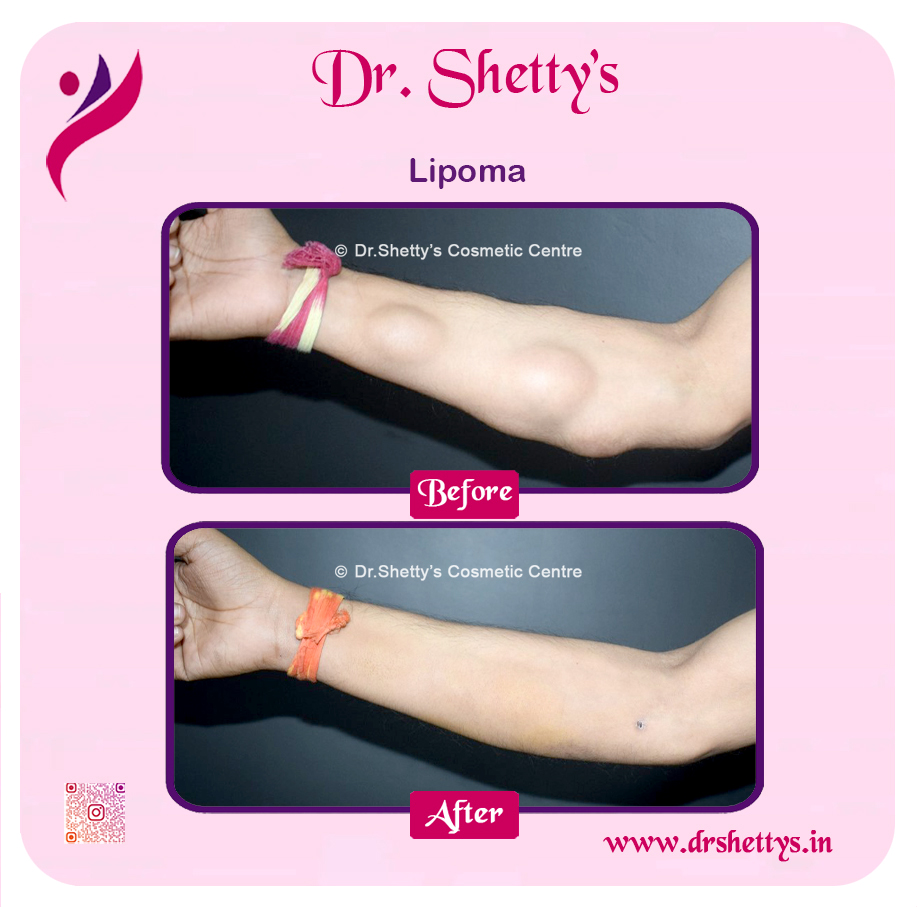 Multiple Lipoma Treatment 13