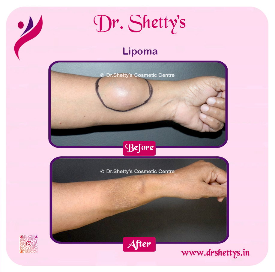 Multiple Lipoma Treatment 15
