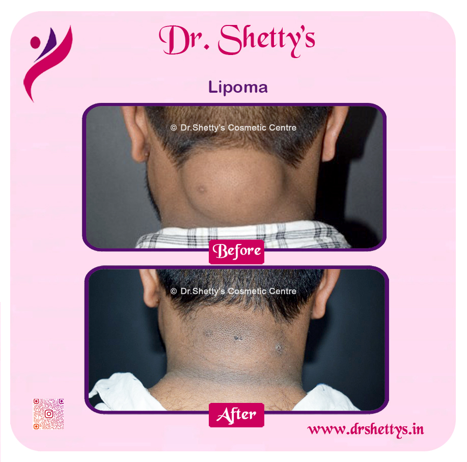 Multiple Lipoma Treatment 16